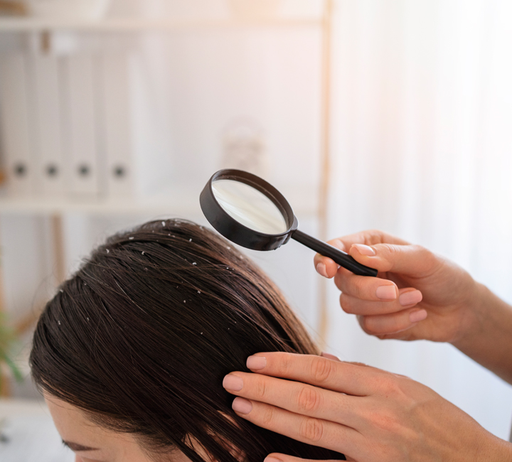 Dandruff Treatment